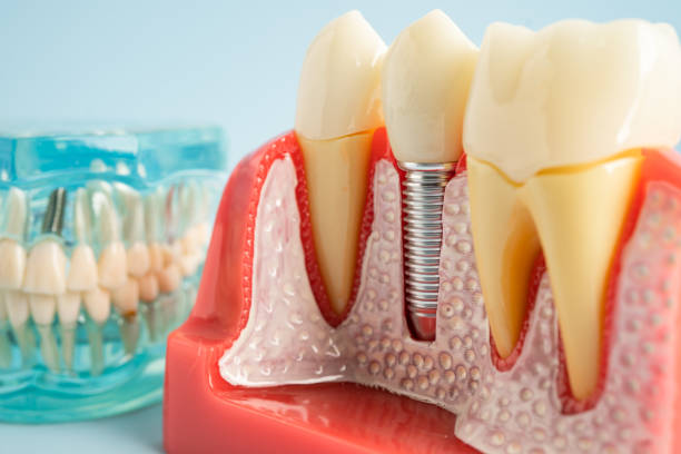 Best Dental Fillings (Composite and Amalgam)  in USA